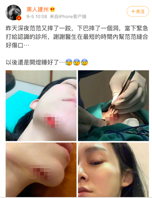 黑人回应范玮琪下巴缝15针 网友：这是第几次摔倒了?