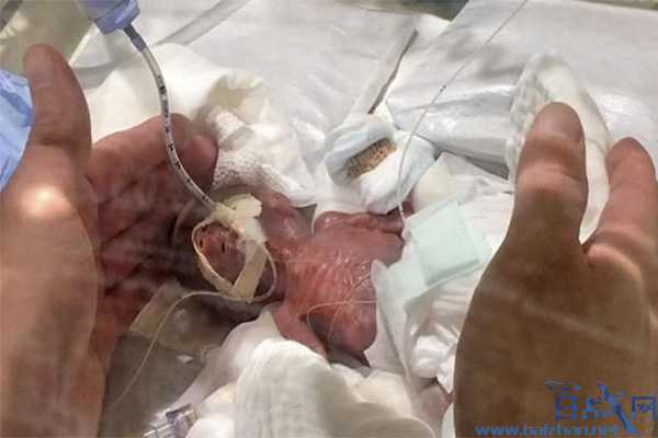世界最小的男婴出院